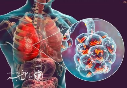 ۶۶ درصد مبتلایان به سل در کشور شناسایی میشوند
